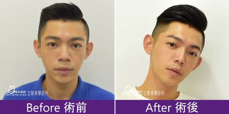 Q鼻+安全可吸收材質撐架
