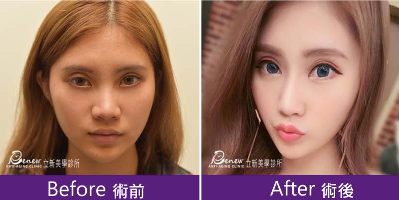 Q鼻+安全可吸收材質撐架