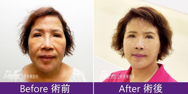 (對比圖)老化問題是多重性且並存的,老化會產生貓咪紋、印地安紋、蘋果肌凹陷、法令紋、顴部水腫、臉頰凹陷、下頷線條模糊、嘴邊肉下垂,耳廓短痕三層次緊顏拉皮可治療中下臉松弛、下垂等問題