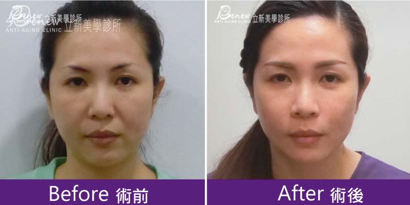 自體法令紋+安全可吸收材質撐架