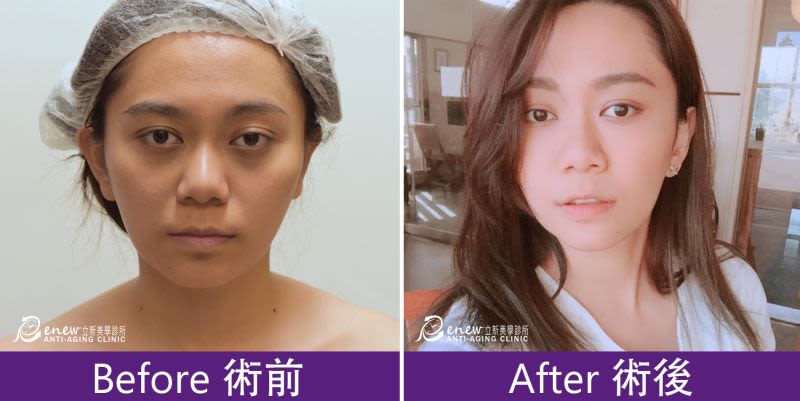 黑眼圈、淚溝