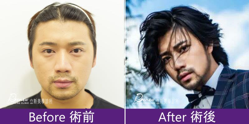 Q鼻+安全可吸收材質撐架