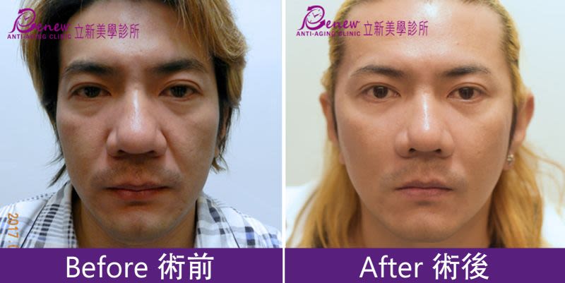 耳廓短痕三層次緊顏拉皮