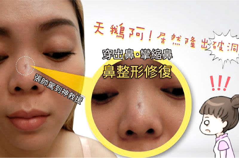驚！越南正妹美的鼻要鼻要～凹洞鼻神再造黃金「鼻」例,手術,隆鼻,立新美學診所
