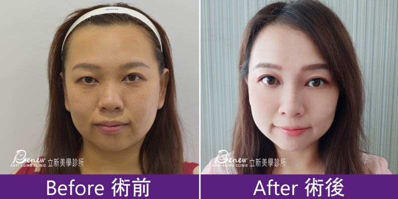 Q鼻+安全可吸收材質撐架