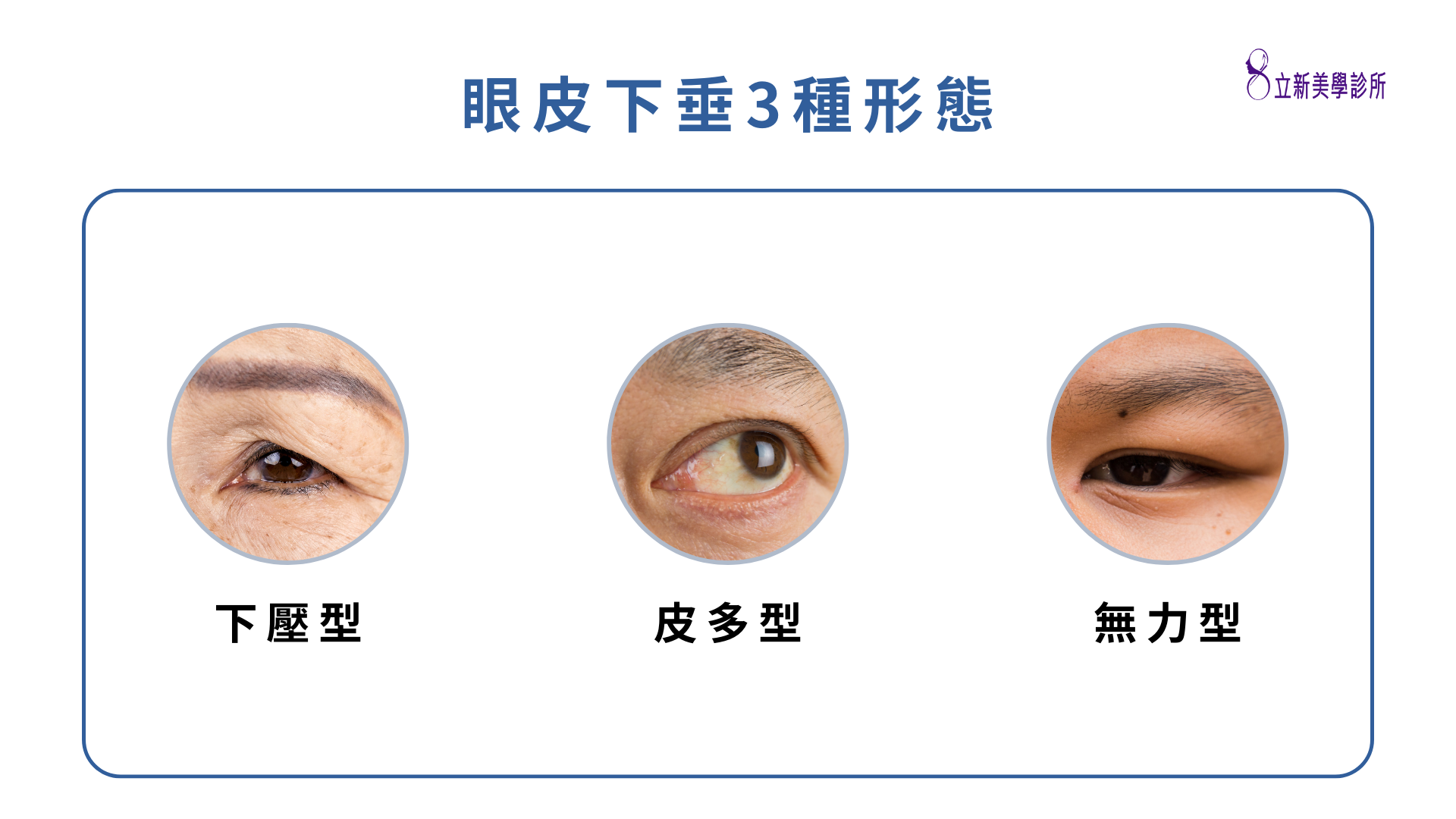 眼皮下垂3種形態，下壓型、皮多型、無力型