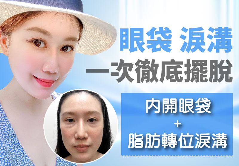 除眼袋+脂肪轉位補淚溝