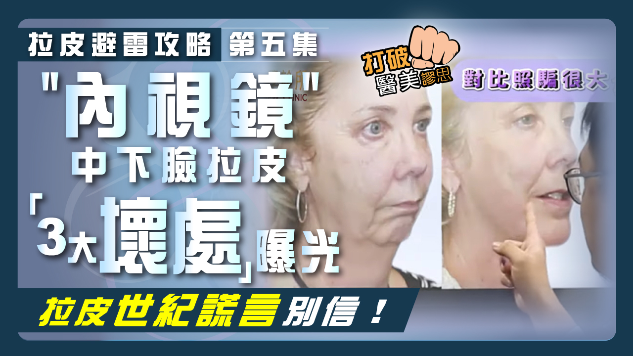 【拉皮避雷攻略｜第五集】別被神化的"內視鏡"拉皮誤導！ 拉皮權威曝內視鏡中下臉拉皮手術「3大壞處」 拉皮前不看會後悔