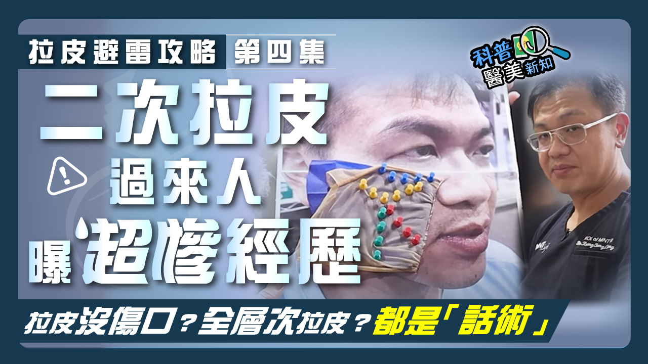 【拉皮避雷攻略｜第四集】用埋線(俗稱)拉提假冒拉皮手術！　拉皮後竟沒傷口、無修復期？全層次拉皮又是什麼？ 帶你一眼看穿拉皮銷售話術