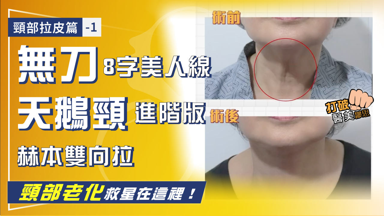 頸部拉皮篇-1｜頸部鬆弛、頸紋 打電波音波效果維持不久？ 脖子老化超強救星在這裡！無刀「8字美人線」 & 天鵝頸進階版「赫本頸闊雙向拉」