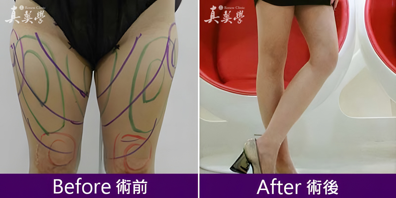 大腿抽脂術前術後對比照