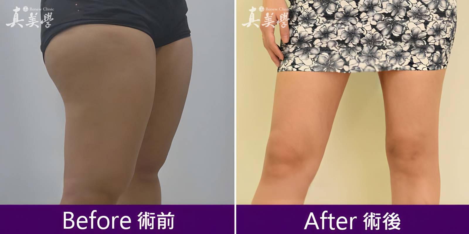 腿部曲線改善術前術後對比照