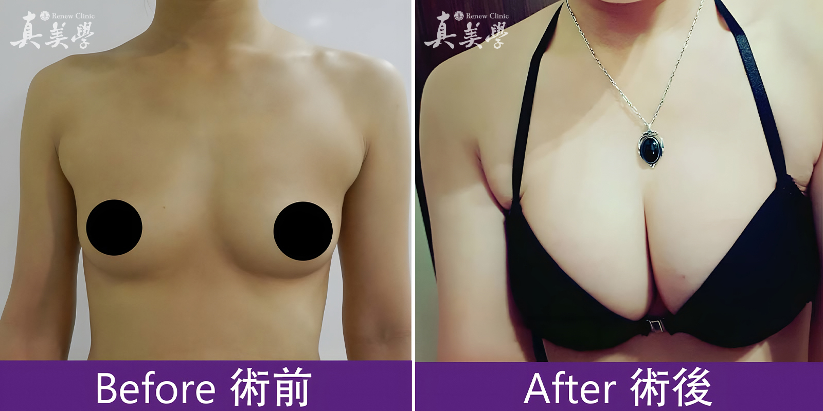 自體脂肪隆乳術前術後對比照