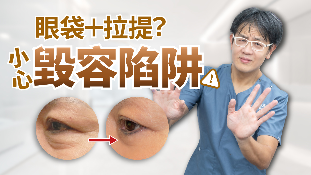 【醫美別亂花錢EP9-2】開眼袋加做「蘋果肌拉提」穩外翻？ 權威狠打臉：法令紋、貓咪紋消不掉！