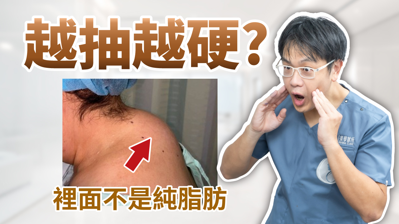 【醫美別亂花錢EP10】富貴包／水牛肩消除指南：為何傳統抽脂無效？深層纖維結構與「螺旋刀」微創技術解析