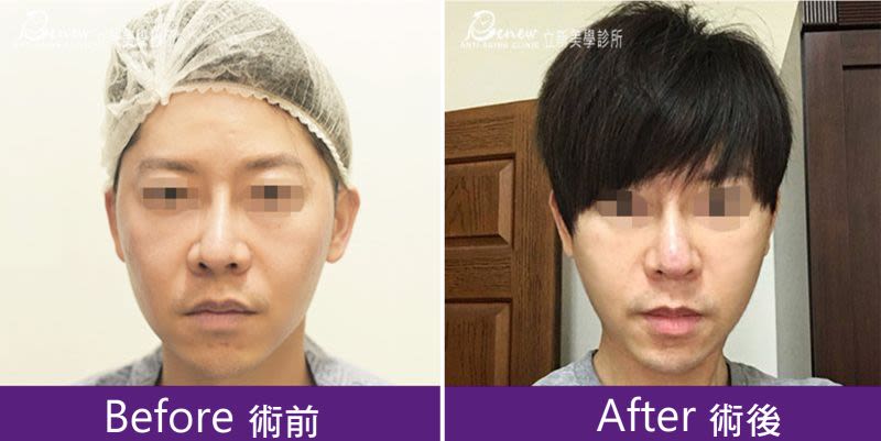 強升8字與強升8字網狀案例術前術後正面臉部對照圖