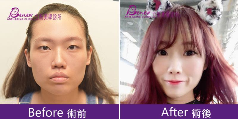 強升8字與強升8字網狀案例術前術後正面臉部對照圖