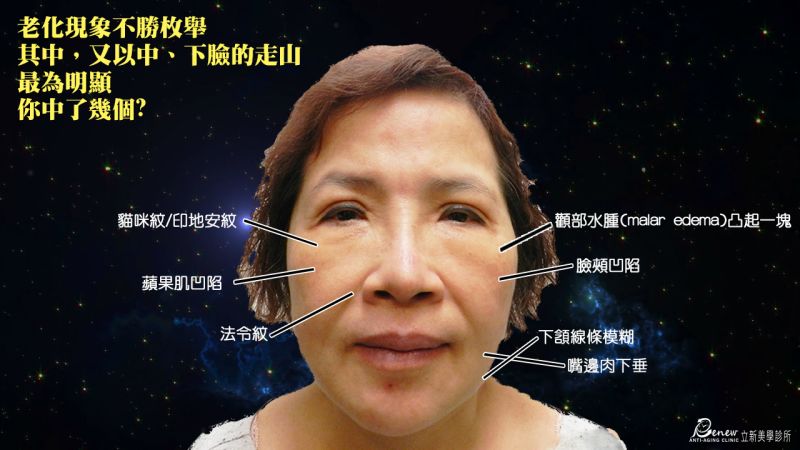 二代8字埋線拉提改善老化導致貓咪紋、印地安紋、蘋果肌凹陷、法令紋、顴部水腫、臉頰凹陷、下頷線條模糊、嘴邊肉下垂