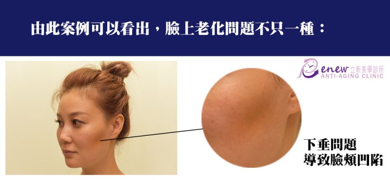 臉上老化問題不只一種，下垂問題導致臉頰凹陷