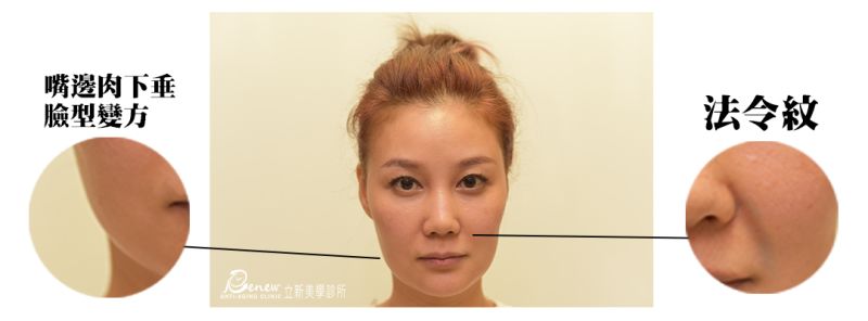 嘴邊肉下垂導致臉型變方、蘋果肌下垂導致法令紋產生