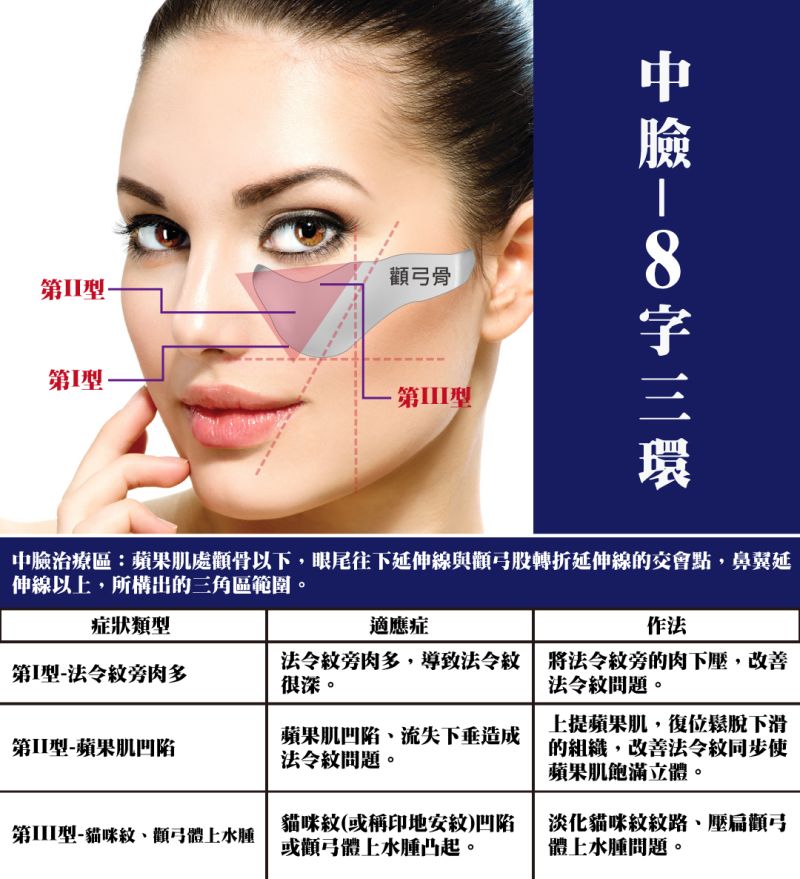 二代8字-8字三環埋線拉提解決中臉的法令紋、蘋果肌凹陷、貓咪紋(印地安紋)、顴弓體上水腫問題