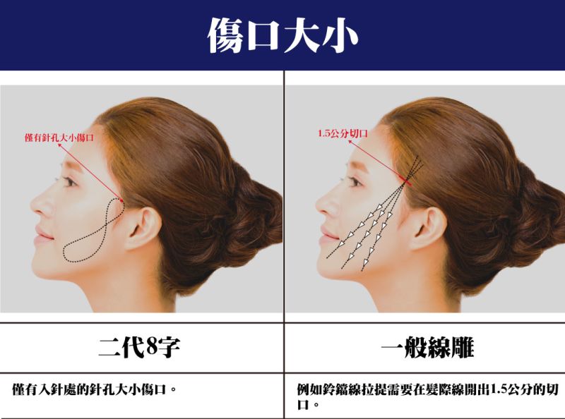 鈴鐺線拉提須在發際線開出1.5公分的切口，二代8字埋線拉提線雕僅需入針處的針孔大小傷口。