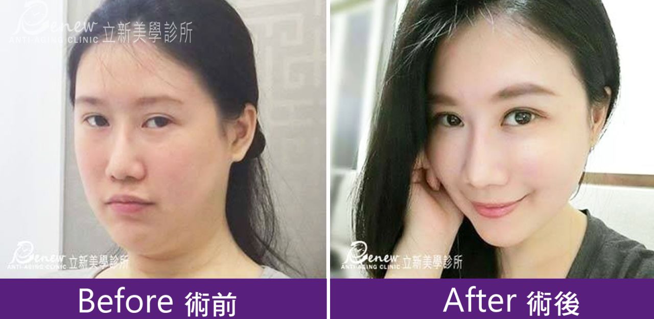 (對比圖)二代8字術前術後照片改善輪廓線松弛，緊緻下頷線